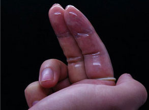 避孕套套手指上避孕